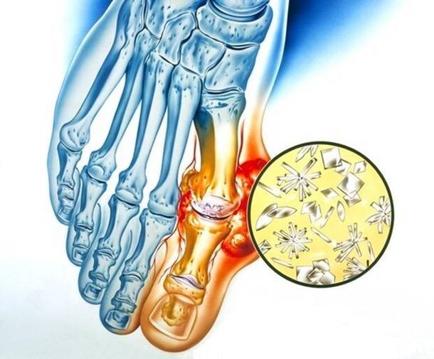 Dépôt d'urate dans la goutte, qui provoque une inflammation de l'articulation